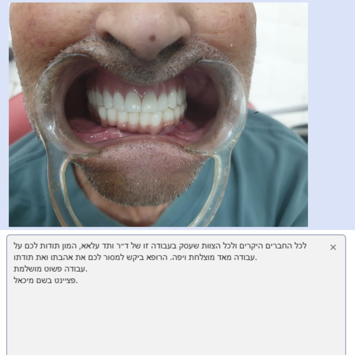 Últimos blogs da empresa sobre Fábrica de processamento de próteses dentárias Joydentalab: Ganhando o elogio sincero dos pacientes com qualidade