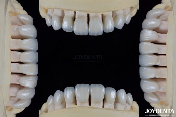 Cerâmica Para Estética Natural Veneers Dentários Resistente a Manchas Mantenha o Brilho Forte Ligação com Esmalte Dental Para Ajuste Seguro