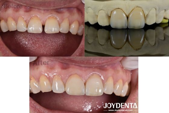 0.5mm Espessura Veneers Dentários Permeabilidade Perfeita Veneers de porcelana para dentes espaçados