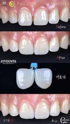 Indicação dos dentes anteriores Finetes dentários sem necessidade de preparação e sem descoloração