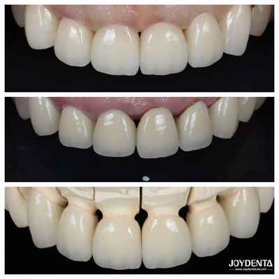 Excelente Biocompatibilidade Folheados de porcelana dental Não é necessário processo de preparação