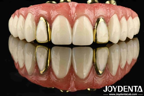 Experimente a durabilidade da ponte híbrida de titânio Malong para odontologia aplicada
