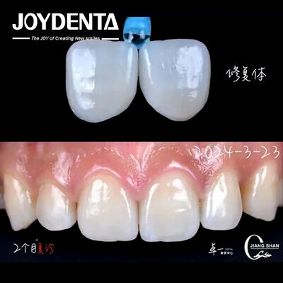 Indicação dos dentes anteriores Finetes dentários sem necessidade de preparação e sem descoloração