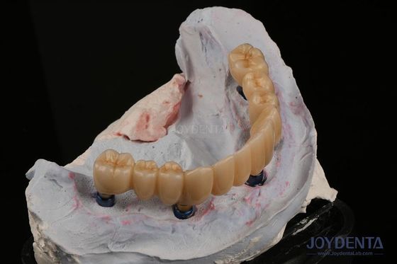 comprar Restauração dentária Implante dentário múltiplo Endossético Substitua dois dentes da frente fabricação em linha