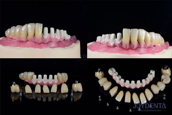 comprar Implantes dentários endossiais múltiplos Conexão interna para restauração de arco completo fabricação em linha