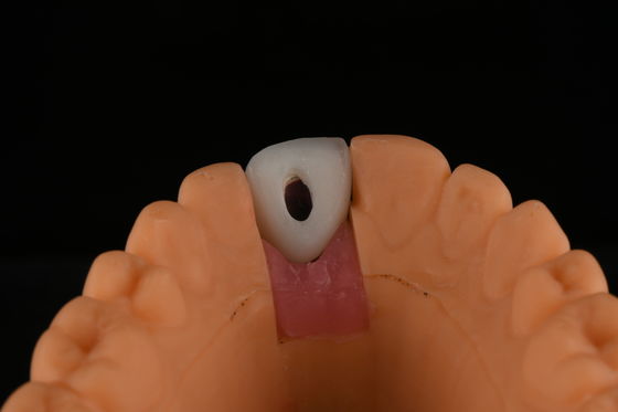 comprar Implantes dentais de titânio de superfície rugosa Cirurgia para substituição de dente frontal fabricação em linha