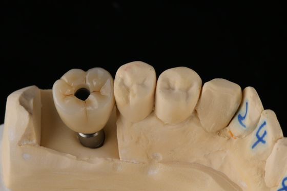 comprar 3Implante Dental de Titânio de.75mm Prata Implante de Substituição de Dente Único fabricação em linha