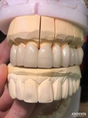 comprar Porcelana de ajuste de precisão fundida a metal PFM coroas sem costura aumento do sorriso natural fabricação em linha
