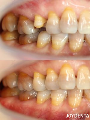 comprar Personalizavel Inlay Dental Acessível Restaurativo Precisamente Adequado para Dentes Danados fabricação em linha