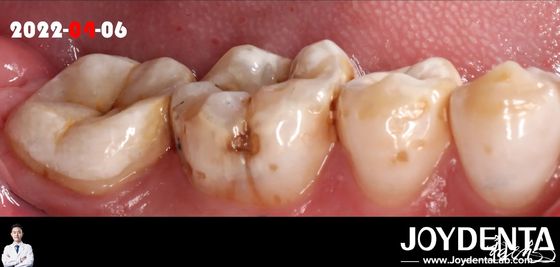 comprar Cor natural, inserção dentária adequada para restauração de dentes danificados fabricação em linha