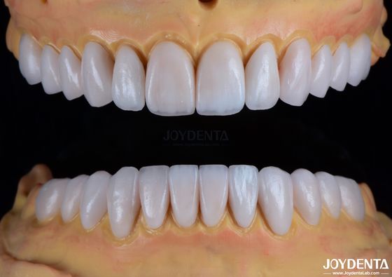 comprar Veneers de porcelana Emax feitos sob medida Textura lisa Restaurações dentárias fabricação em linha
