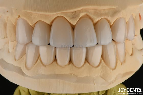 comprar 0.3-0.5mm espessura Feldspathic Porcelana Veneer Alta resistência à fratura Upgrade seu sorriso fabricação em linha