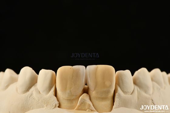 comprar 0.2mm Espessura Microthin Veneers Veneers Dental Cerâmica de vidro para Dentes Frontais fabricação em linha