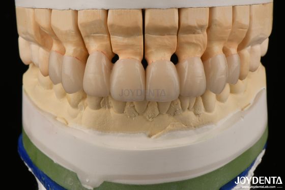 comprar Coroas de zircônio em camadas de alta translucidez Pontes Restaurações dentárias Aparência realista fabricação em linha