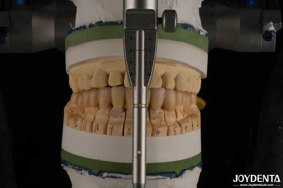 comprar Alta Estética Porcelana Zirconia Dental em Camadas Para Restaurações de Implantes fabricação em linha