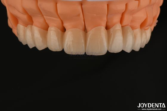 comprar Ponte de coroa única de zircônio em camadas de alta estética Implante para restaurações dentárias fabricação em linha