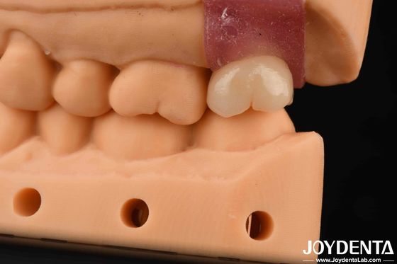 comprar 4.1mm V em forma de fio abutments de titânio com conexão hexadecimal interna fabricação em linha