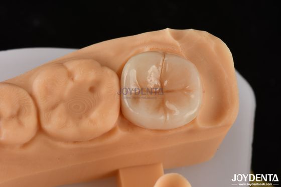 comprar 0.5mm-2mm Precise Fit Emax Dental Inlay Onlay para restauração de dentes confiável fabricação em linha