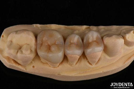comprar Aparência natural Emax Inlay Onlay Restauração dental duradoura 0,5 mm 1 mm 1,5 mm espessura fabricação em linha