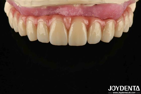 comprar Confortável Uso Titânio Malong Hybrid Bridge Dental Design ajustável Peso leve fabricação em linha