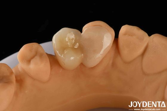 comprar Emax Maryland Veneer Clinical Bonding Adhesion para reparação dental de cores correspondentes fabricação em linha