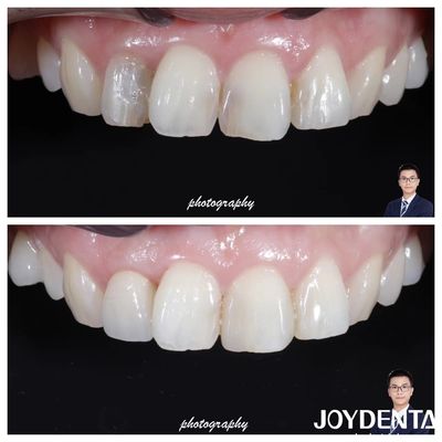comprar Estética Translucidez Coroas de zircônio de aparência natural Alta resistência à fratura fabricação em linha