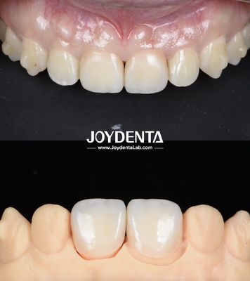 comprar Ponte dentária de zircônio de superfície lisa e leve para restaurações com implante fabricação em linha