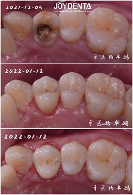 comprar Porcelana Dental de Ajuste Precise Inlay Restauração de Dentes Danados para Adultos e Crianças fabricação em linha