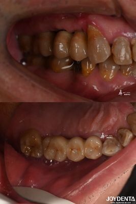 comprar Implante dentário de superfície áspera para material de titânio no nível ósseo subcrestal fabricação em linha