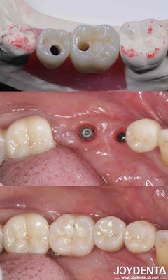 comprar Implantes dentários de titânio cilindricos todos em 4 10-16mm de comprimento conexão hex fabricação em linha