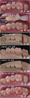 comprar Processo Dental de inserção de porcelana sem costura Forma personalizável para reparação de dentes fabricação em linha