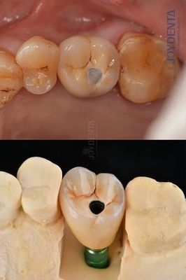 comprar Implantes Dentários de Titânio de Arco Completo Plataforma Protética 4.1mm Para Durabilidade Excepcional fabricação em linha