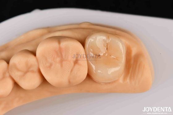 comprar Alta resistência Emax Inlay Onlay A2 Cor Durável Para Restauração de Dentes Danados fabricação em linha