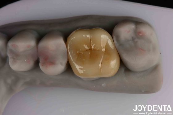 comprar Translucidez média Emax Inlay Onlay Fácil limpeza e biocompatibilidade não tóxica nos materiais fabricação em linha