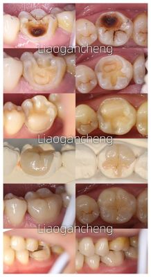 comprar Inlay Dental de porcelana restaurador para adultos e crianças desempenho excepcional fabricação em linha