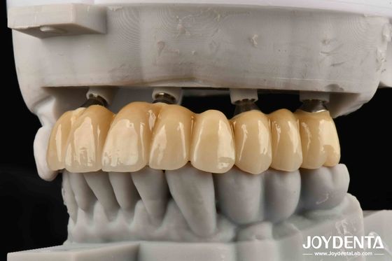 comprar Amigos Próximos da Fundação Bones Of Beauty Implantes de Zircônia Uma Escolha Esteticamente Superior Sem Risco de Alergia a Metal fabricação em linha