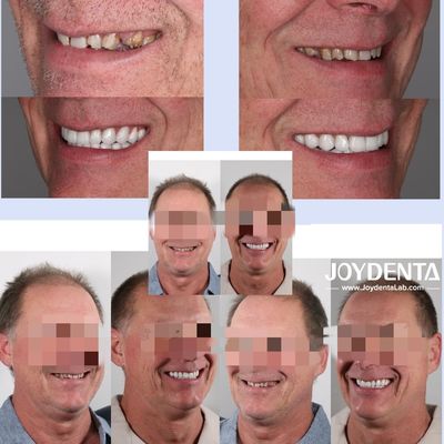 comprar Prótese circónica que imita os dentes naturais fabricação em linha
