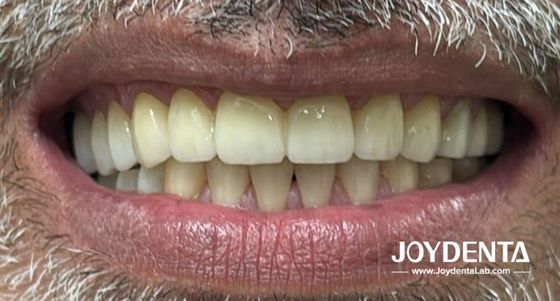 comprar Prótese circónica que imita os dentes naturais fabricação em linha