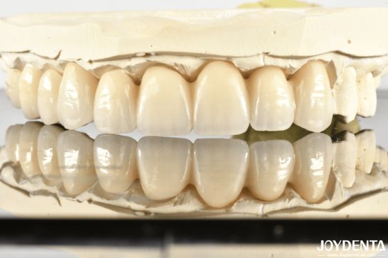 comprar Revolutionize Aesthetics & Strength: Introducing Our Multi-Layered Chromatic Zirconia Bridge fabricação em linha