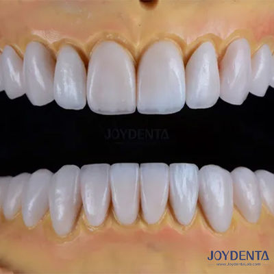comprar Veneers de porcelana Emax feitos sob medida Textura lisa Restaurações dentárias fabricação em linha