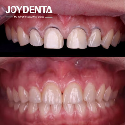 comprar Laboratório de Estética Odontológica de Veneers Dentários. fabricação em linha