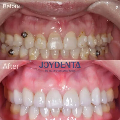 comprar Folheados dentários para dentes perdidos. fabricação em linha