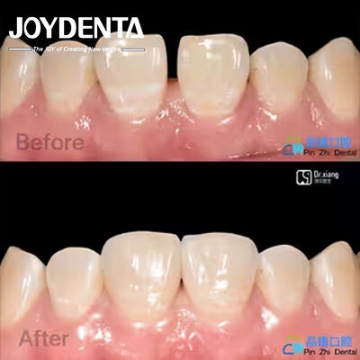 comprar Proteção contra manchas de revestimento de porcelana Tratamento dentário revestimento de resina composta resistente a manchas fabricação em linha