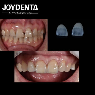 comprar 0.5mm Espessura Cerâmica Veneers Dentários Natural Procurando Dentes Anteriores Indicação fabricação em linha