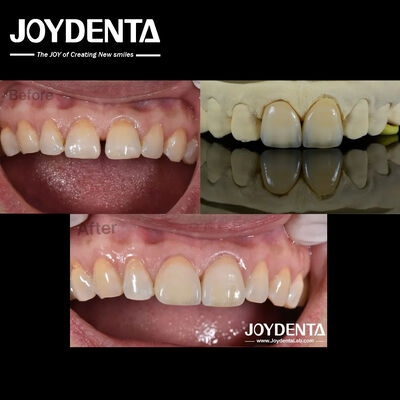 comprar 0.5mm Espessura Veneers Dentários Permeabilidade Perfeita Veneers de porcelana para dentes espaçados fabricação em linha