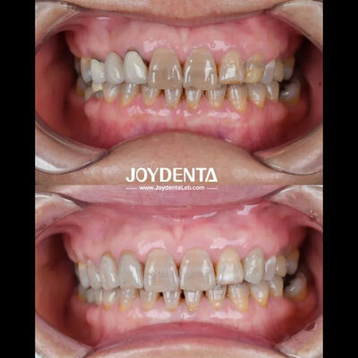 comprar Circônio Dental Leve Para Uma Optima Experiência do Paciente Cor Natural fabricação em linha