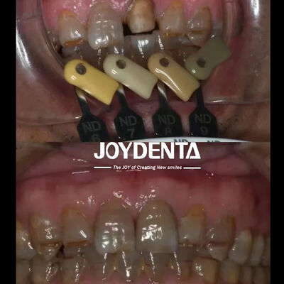 comprar Coroas de zircônio translúcidas Tecnologia de gradiente multicamadas fabricação em linha