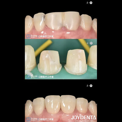 comprar Coroas Dentárias de Zircônia com Ajuste Perfeito e Sistemas CAD CAM fabricação em linha