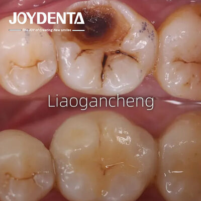 comprar Inlay Dental de porcelana restaurador para adultos e crianças desempenho excepcional fabricação em linha