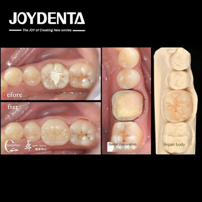 comprar Biocompatibilidade e alta compatibilidade com a restauração de dentes naturais fabricação em linha